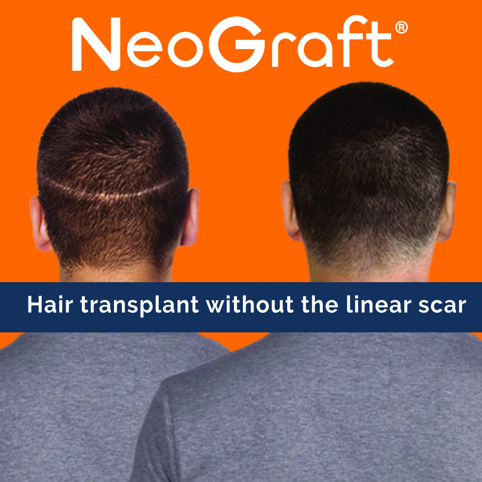 neograft hair transplant ad
